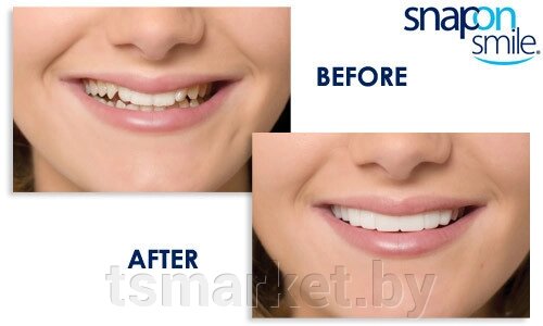 Накладные зубы (виниры) Snap on smile декоративные от компании TSmarket - фото 1